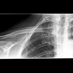 rx_clavicola_radiografie_domicilio_torino