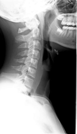 rx cervicale 