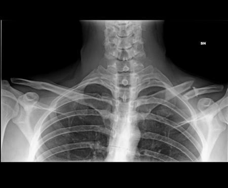 rx clavicola 